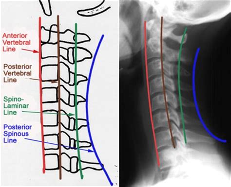 Cervical Spine Trauma Evaluation Spine Orthobullets