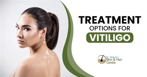 What Are The Best Treatment Options For Treating Vitiligo Successfully