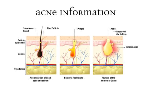 The Basics Of Adult Acne Care Blog Beauty Tips Lionesse