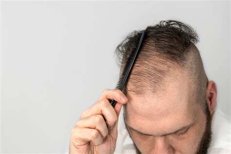 Hair Thinning In Toronto Find Out How Your Hair Loss Cure Measures Up