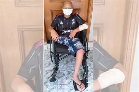 Menino De 12 Anos Que Teve Perna Amputada Pede Ajuda Para Ganhar Prótese Em Ibirá Sp
