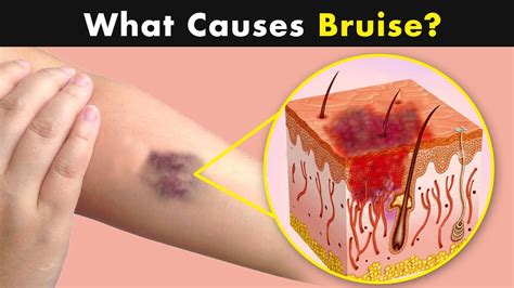 Bruises Why Does It Happens Symptoms Causes And Treatment Urdu