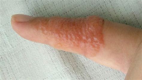 Allergy Trigger What Causes Small Bumps On Hands That Itch