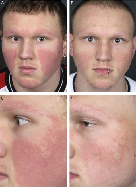 Figure 2 From Successful Treatment Of Severe Keratosis Pilaris Rubra