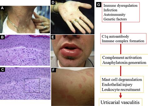 Urticarial Vasculitis And Associated Disorders Annals Of Allergy