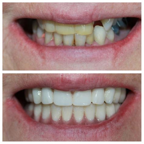 Patient Gallery Before And After Murray Ut White Pine Dental
