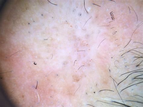 trichotillomania is the hair loss permanent — donovan hair clinic