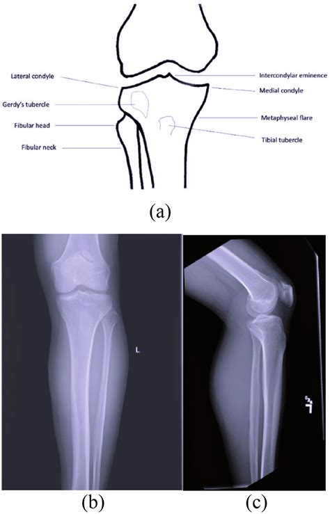 proximal tibia anatomy a and normal plain radiographs of the tibial download scientific
