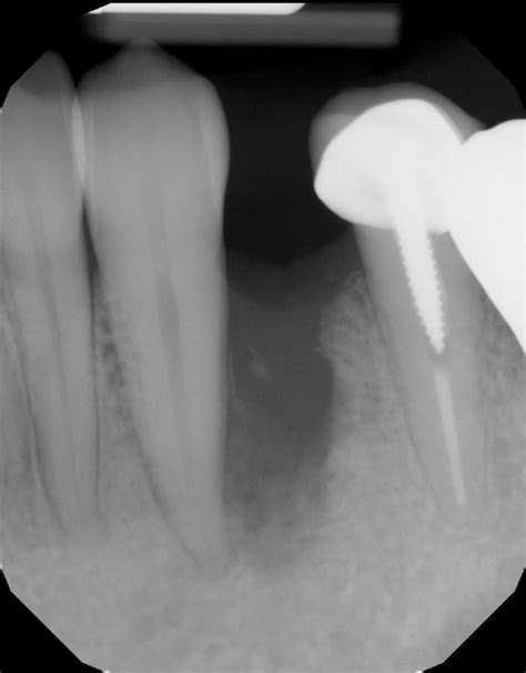 Bone Grafting After Tooth Removal Why When And What To Use Dental