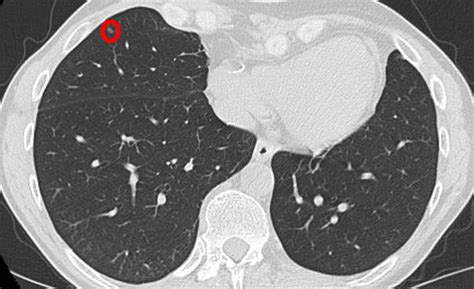 The type of ct scan we carry out is known as a low dose ct of the chest. How to interpret CT scans of your lung