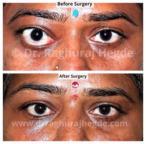 The Eye Of Thyroid Dr Raghuraj Hegde