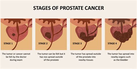 The Four Prostate Cancer Stages What You Need To Know
