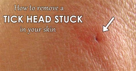 Quick And Easy Tick Head Removal Methods For Skin Removemania
