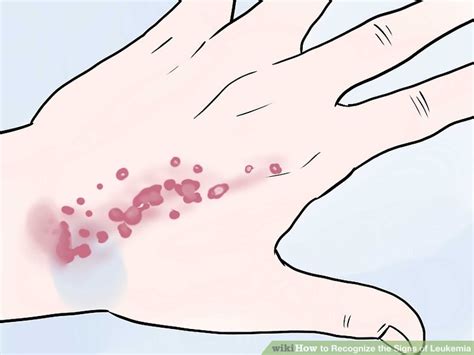 How To Recognize The Signs Of Leukemia 12 Steps With Pictures