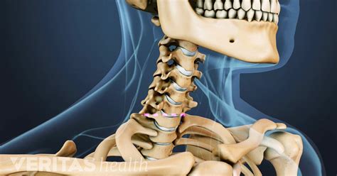 Hospital Care After Cervical Artificial Disc Replacement Surgery