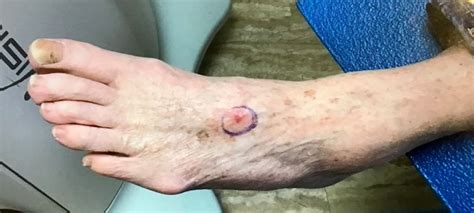 How Skin Cancer Appears On Feet︱gentlecure