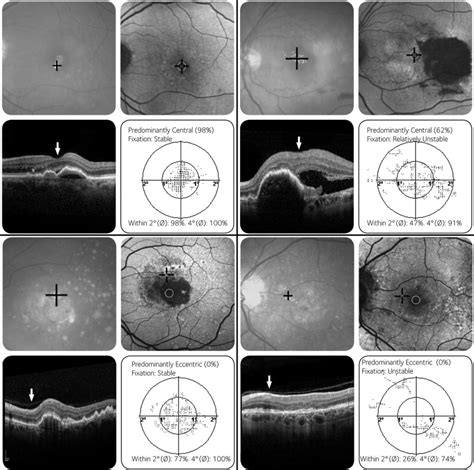 Determinants Of Fixation In Eyes With Neovascular Age Related Macular