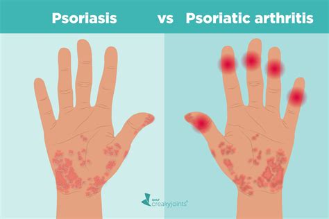 psoriasis and psoriatic arthritis what s the connection