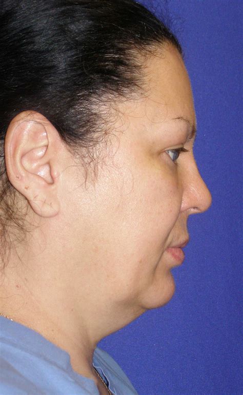 Neck Lift Before & After Photos Seattle Belleveue