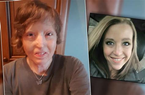 Photos Burned Mom Courtney Waldon Shocking Transformation