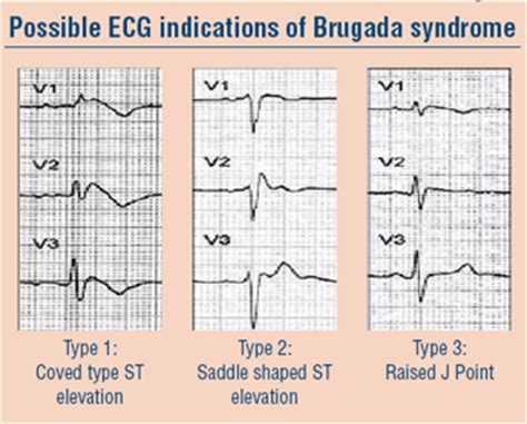 The most likely ecg finding in this patient is sinus tachycardia. Continuing Education - Cardiology - Brugada syndrome