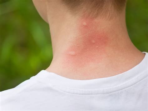 Why Do Some People Get Bitten By Mosquitoes More Than Others Kays Medical