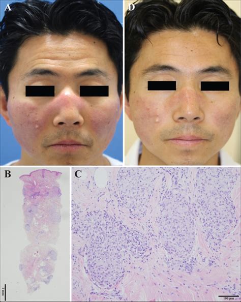 Jle European Journal Of Dermatology Sarcoidosis Mimicking Malar