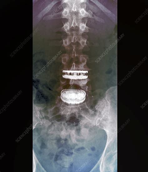 Intervertebral Disc Implants X Ray Stock Image C0488092 Science