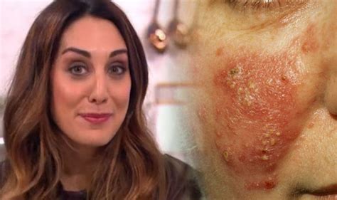 Rosacea Treatment This Mornings Dr Sara Reveals You Can Reduce