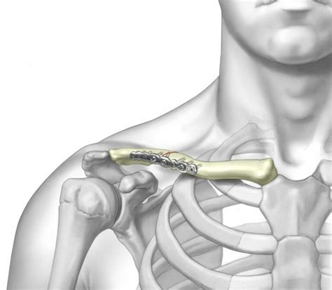 Anterior Clavicle Plate Ortho Providers