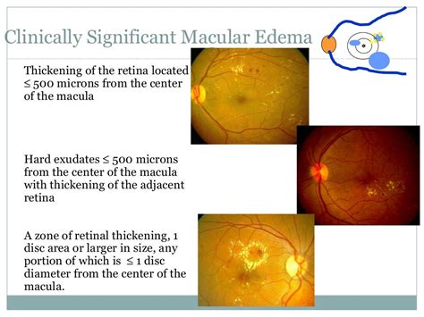 Diabetic Maculopathy