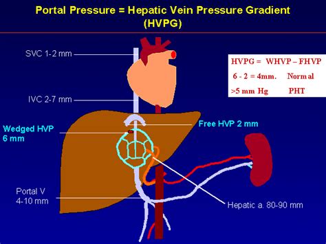 Portal Pressure Hepatic Vein Pressure Gradient Hvpg