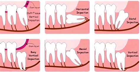 Symptoms And Signs That Your Wisdom Teeth Are Coming In Boston Dentist Congress Dental Group