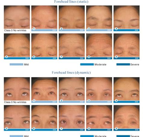 Classification Of Facial Wrinkles Among Chinese Women