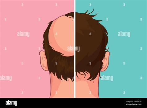 Hair Loss Stages Of Alopecia Man Problem Vector Medical Health