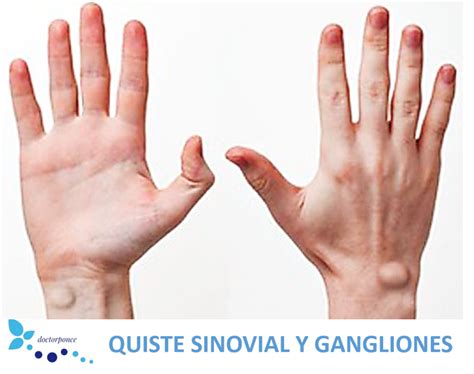 Quiste Sinovial Y Gangliones Clínica Reumatológica Dr Ponce