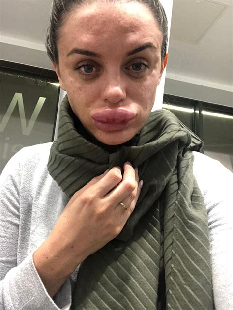 Botox Gone Wrong Womans Lips Left Swollen After Getting Fillers From