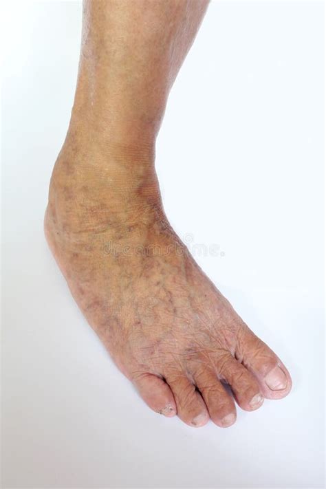 Varicose Veins In The Feet And Legs Stock Image Image Of Compassion