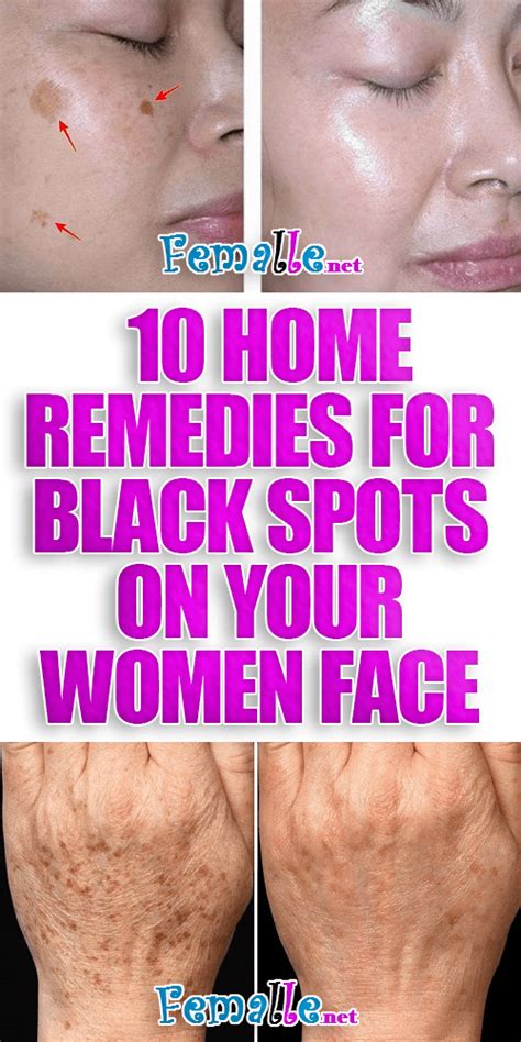 10 Home Remedies For Black Spots On Your Women Face Woman Face Black