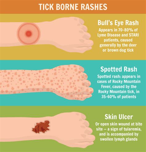 Tick Bite Rash How To Recognize The Symptoms Treatment Tips
