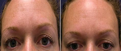 Chicago Brow Lift Forehead Lift Patient Pictures And Photos