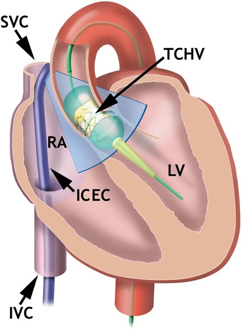 Transcatheter Heart Valve
