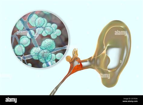 Chronic Fungal Otitis Media Ear Infection Illustration Stock Photo Alamy