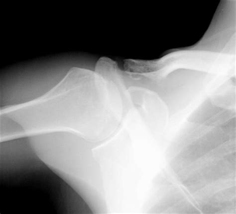 Distal Clavicle Osteolysis Shoulder And Elbow Orthobullets