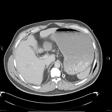 Liver Laceration And Intercostal Artery Laceration Radiology Case