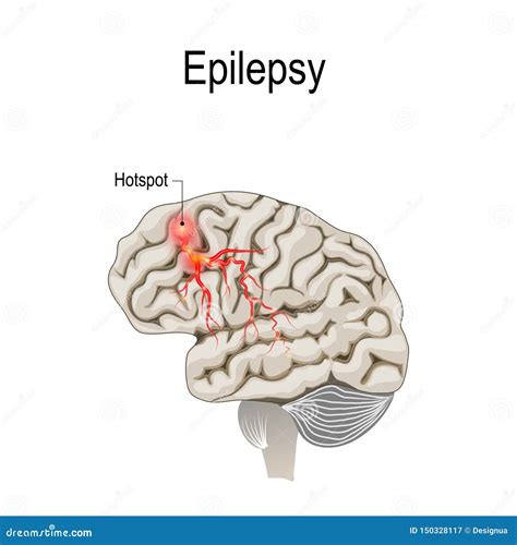 Epilepsy Brain Diagram