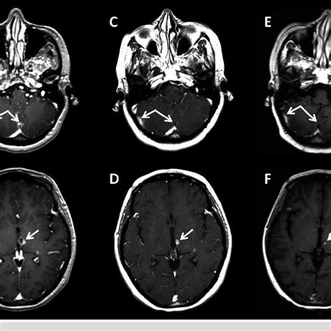 Brain Mri Findings Axial T1 Post Contrast Mri Shows Areas Of Concern