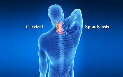 Cervical Lumbar Spondylosis Pain And Treatment Allspine My XXX Hot Girl