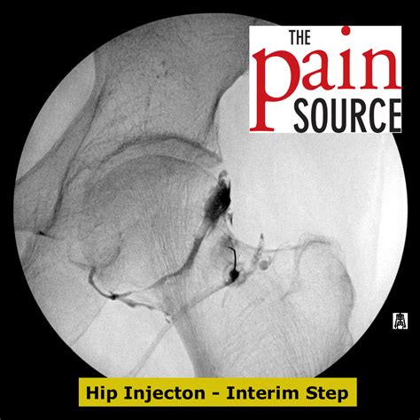 Hip Joint Injection With Fluoroscopy Technique And Tips