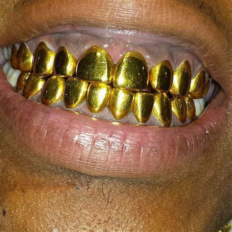 22k Permanent Gold Teeth Prices How Do You Price A Switches